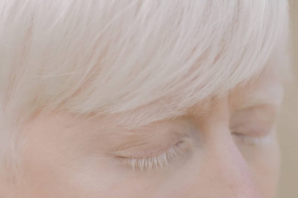 Person with white hair eyebrows and eyelashes